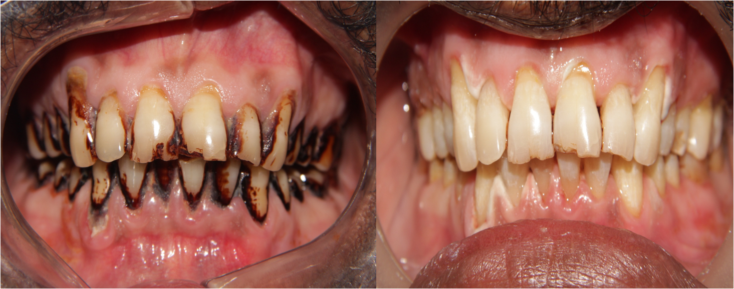 teeth whitening treatment in chennai