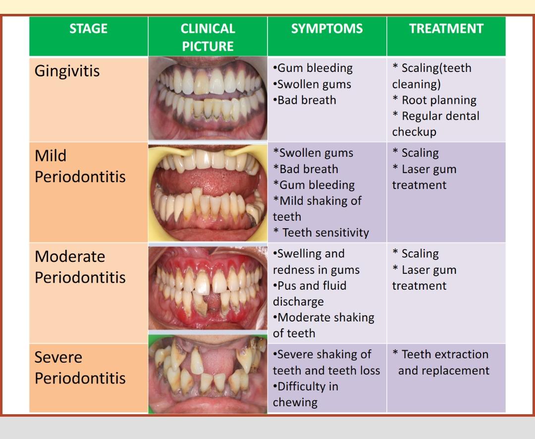 Treatment for gum disease in chennai, mugalivakkam
