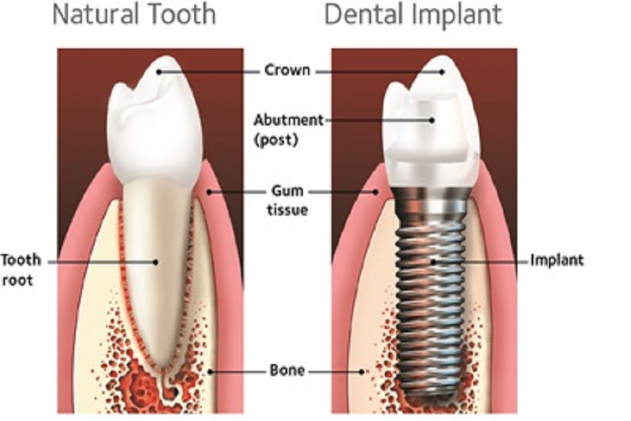 dental implant in chennai