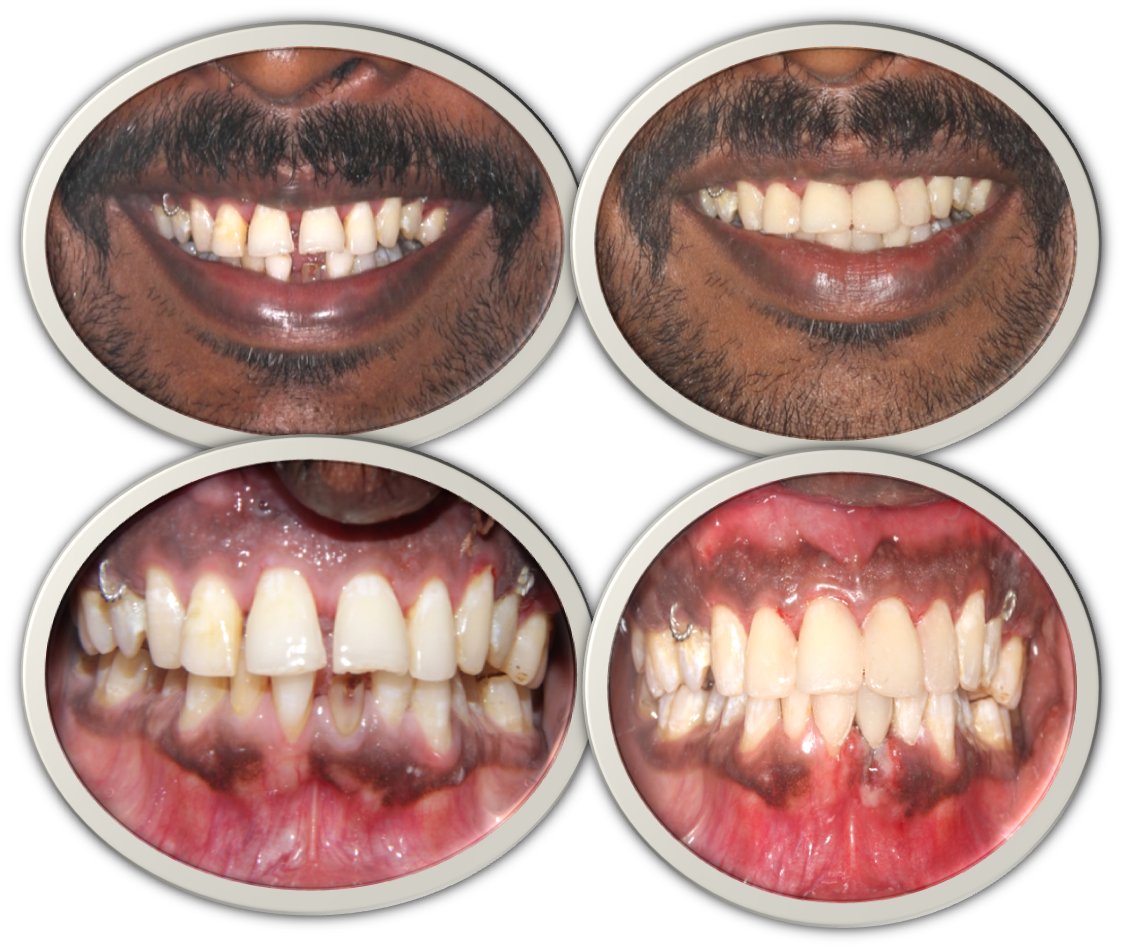 teeth gap filling treatment cost in India,Chennai
