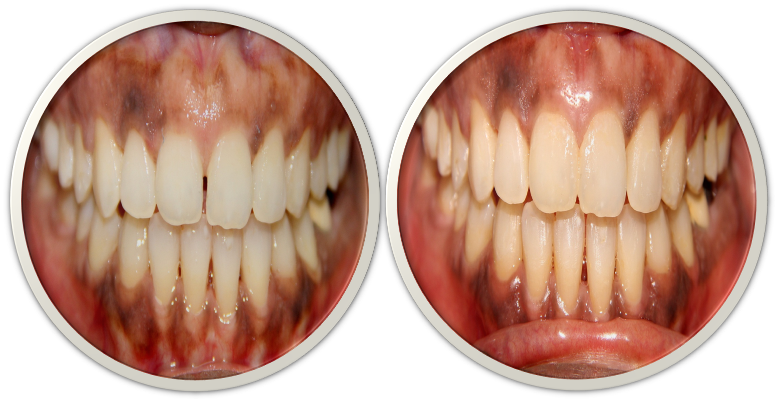 front teeth gap closure(midline diastema) treatment option in India,Chennai