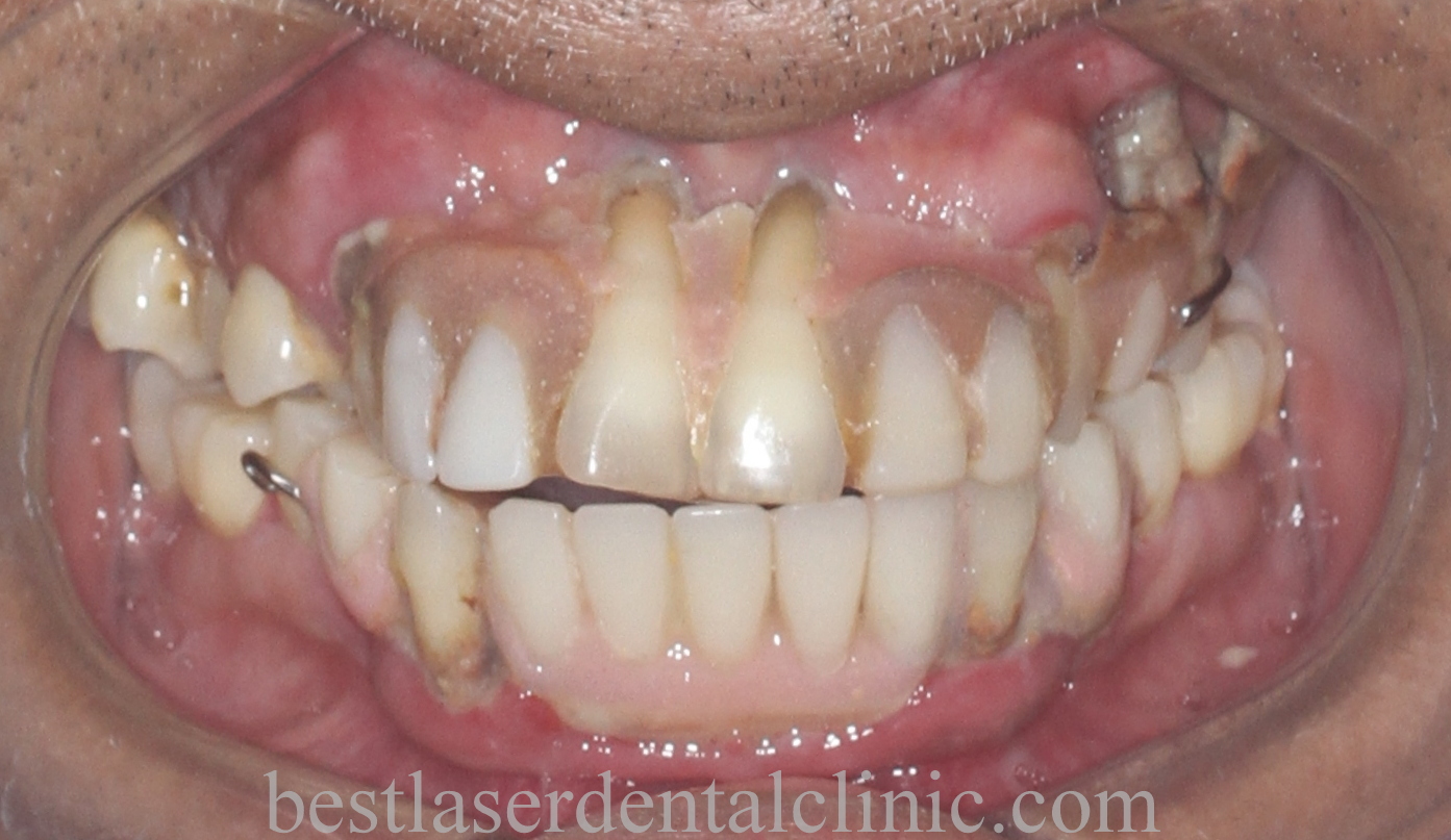 fixed teeth in 3 days in Chennai,India