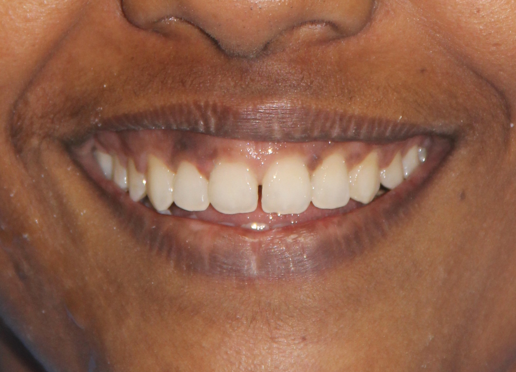 gummy smile treatment in Chennai