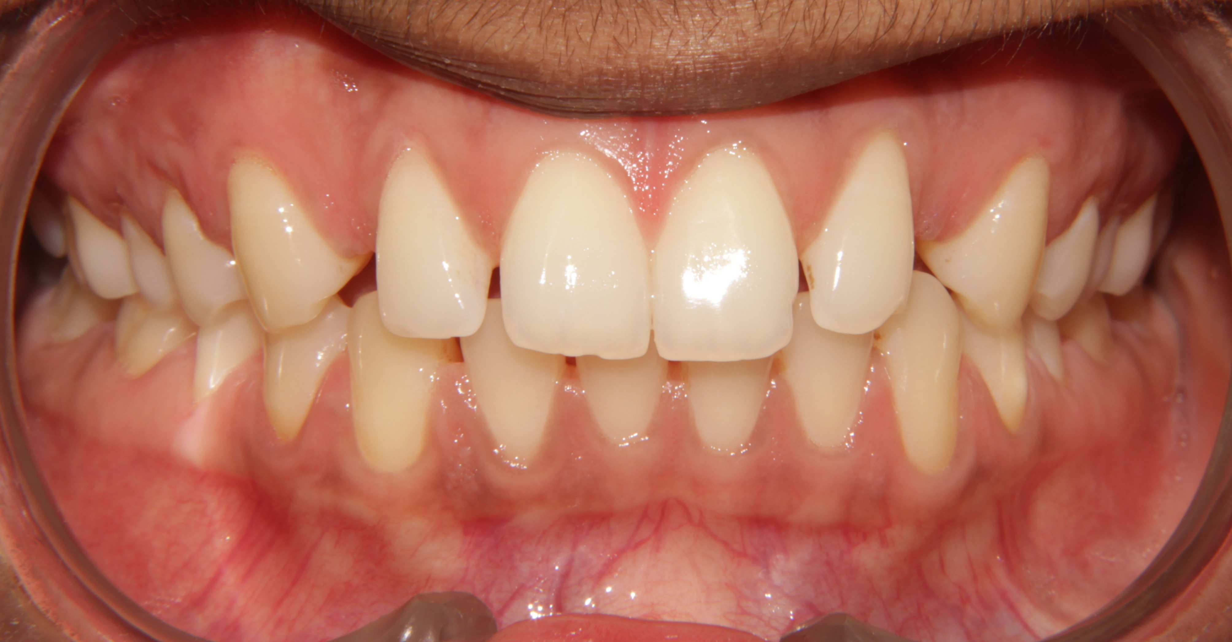 front teeth gap closure treatment in Chennai