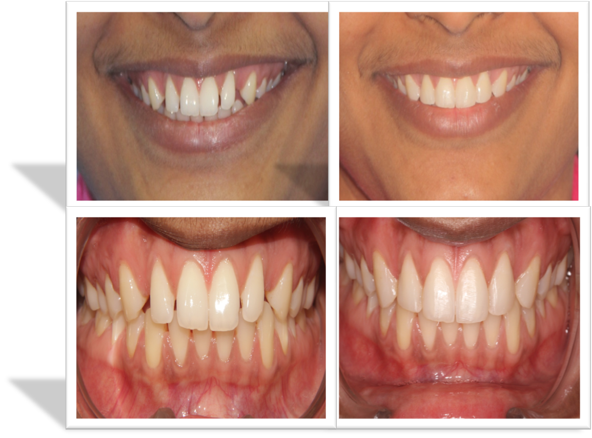 cost of smile designing in India,Chennai