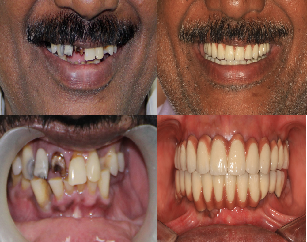 full mouth replacement with dental implants in India,Chennai