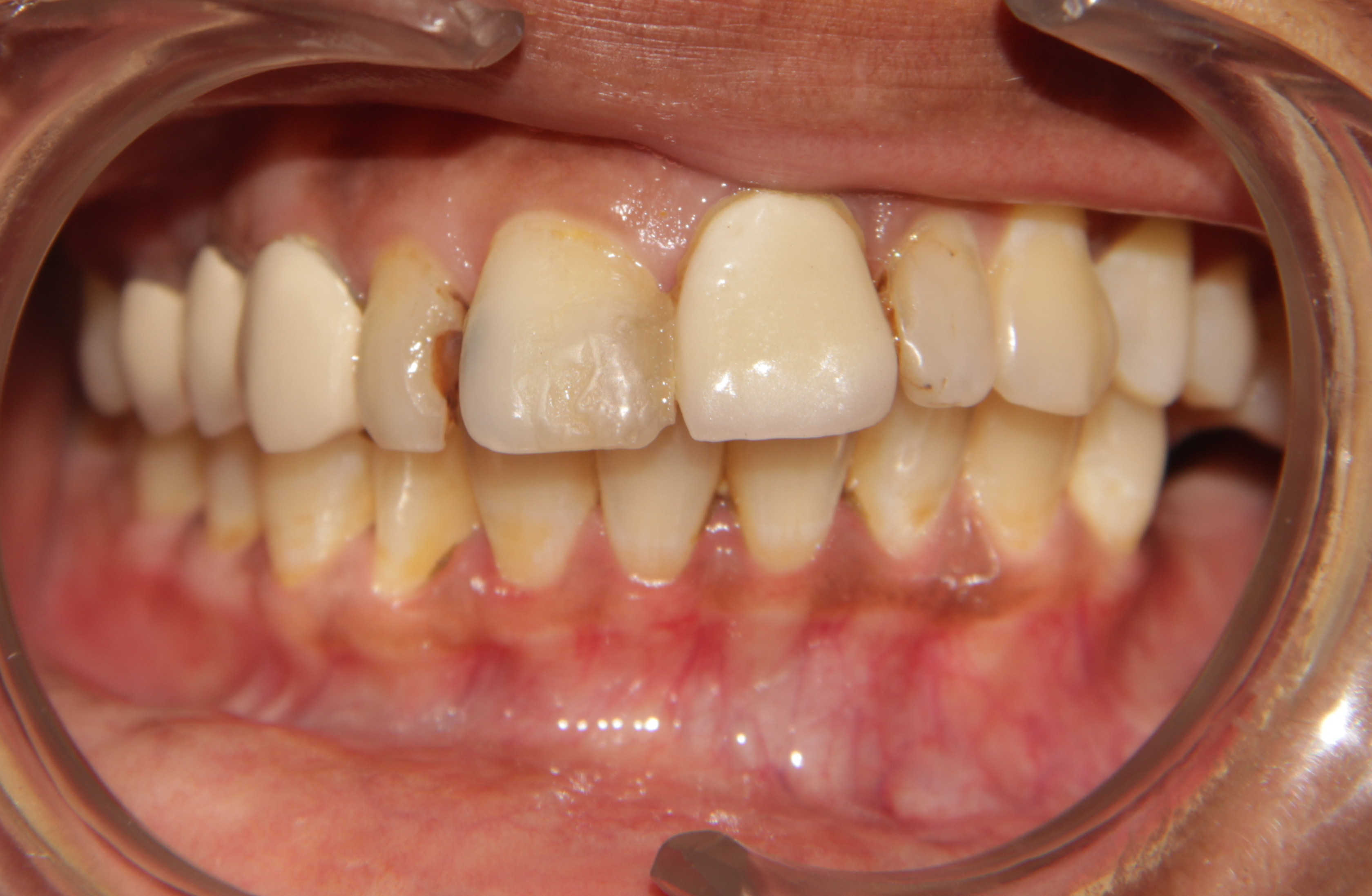 decay in front teeth