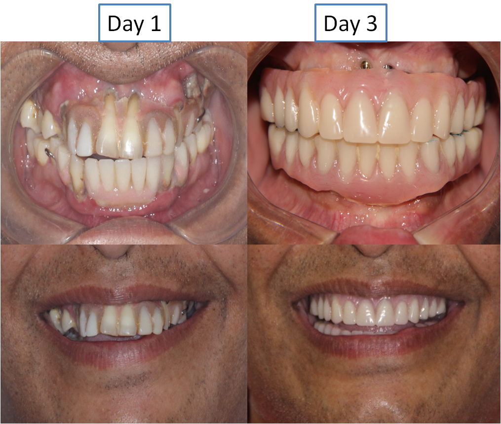 immediate teeth replacement in chennai, India