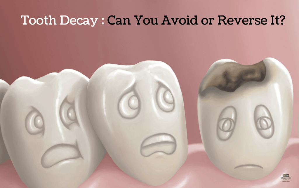 prevention of tooth decay