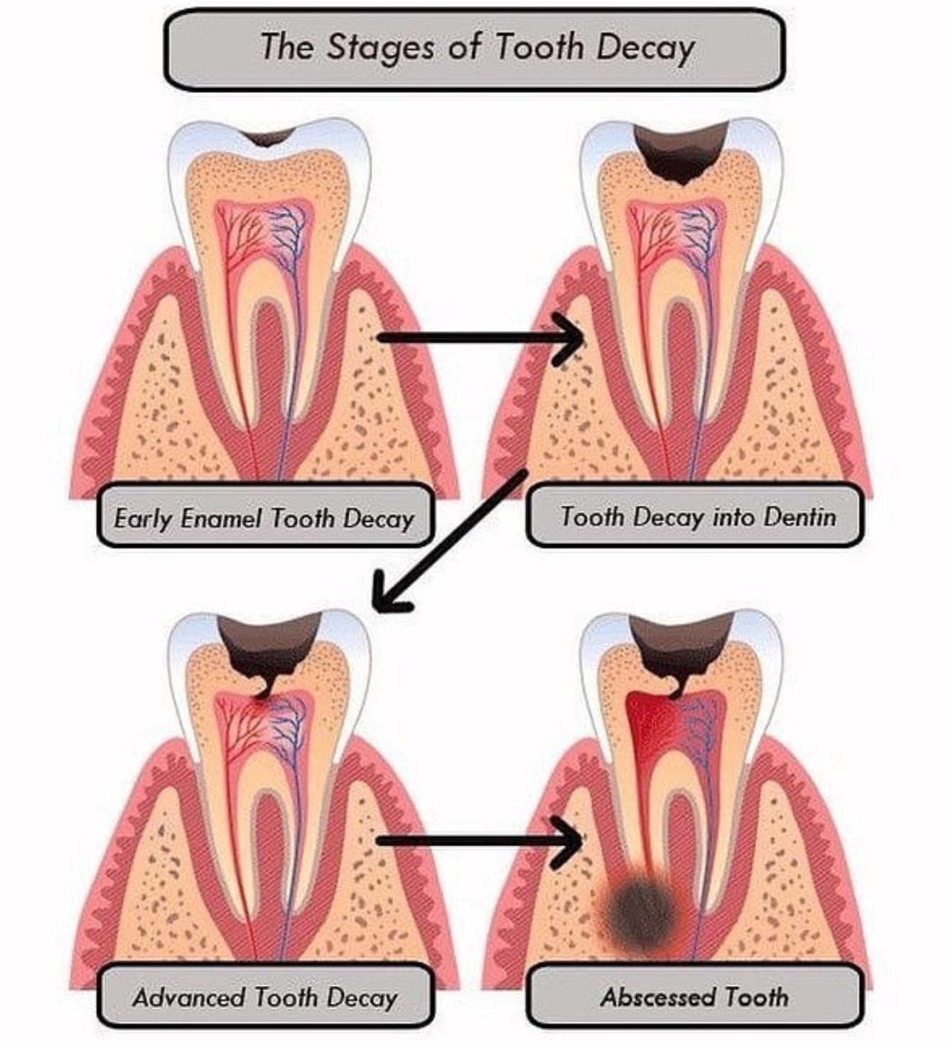 stages of dental caries