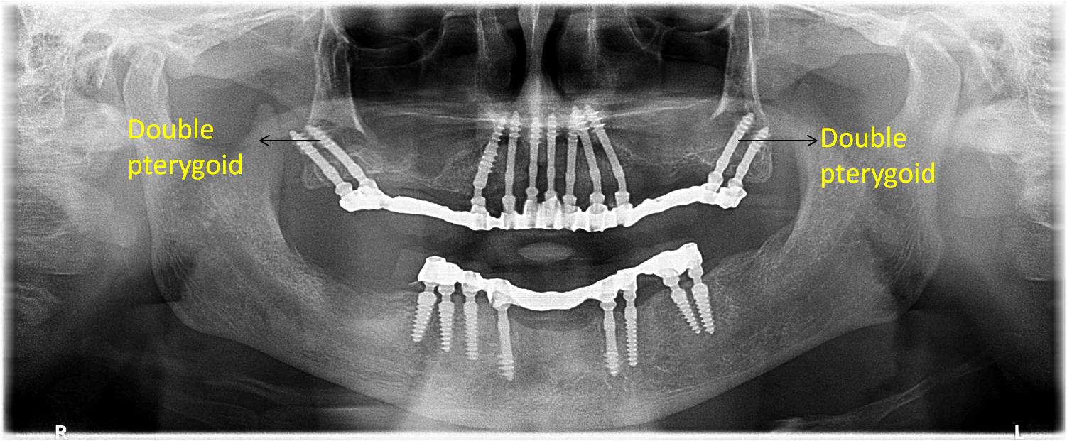 fixed teeth with pterygoid dental implants in India
