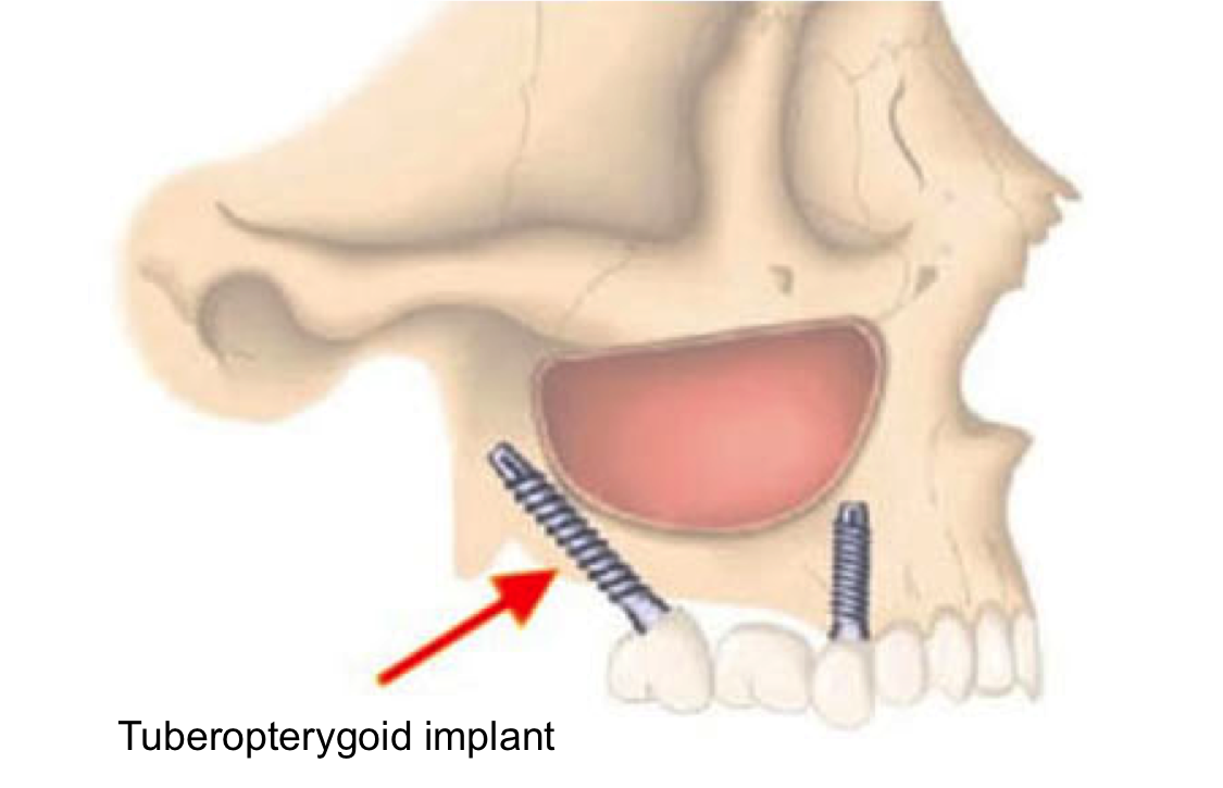 tuberopterygoid dental implants in India