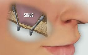avoid sinus lift and bone graft for fixed teeth in India