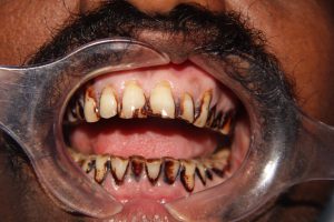 teeth whitening center in chennai, mugalivakkam