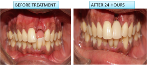 front tooth replacement