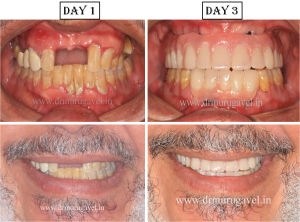 Immediate teeth replacement in chennai