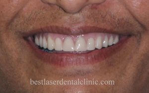 fixed teeth with dental implants in Chennai,India