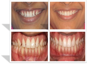 cost of smile designing in India,Chennai