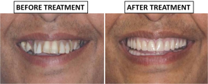 fixed teeth with dental implants in Chennai,India