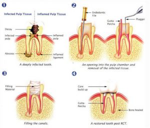 root canal treatment in chennai