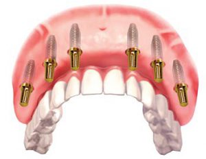 full teeth replacement with all on 6 dental implants in India, Chennai