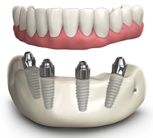 all on 4 dental implants for full mouth replacement in India,Chennai