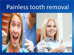 tooth removal
