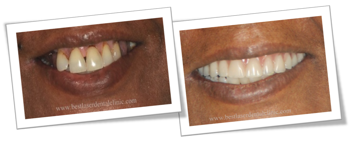 cost of full teeth replacement with dental implants in Chennai, India