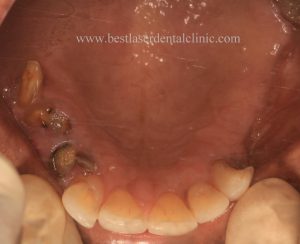 full teeth implant cost in Chennai, India