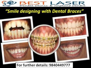 Cost of ceramic teeth braces in Chennai, India